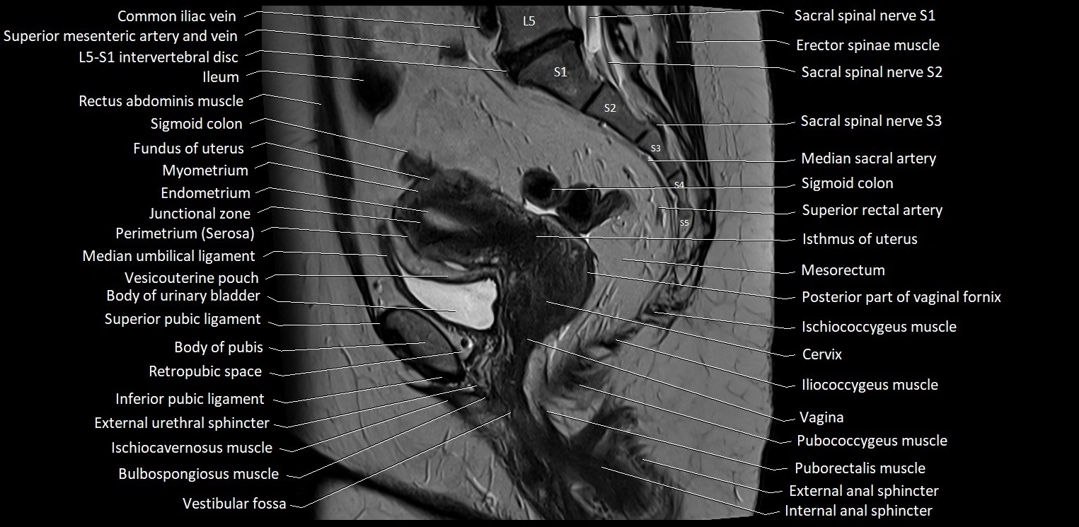 Sagittal cross sectional anatomy of female pelvis (MRI 3T) image 19.webp